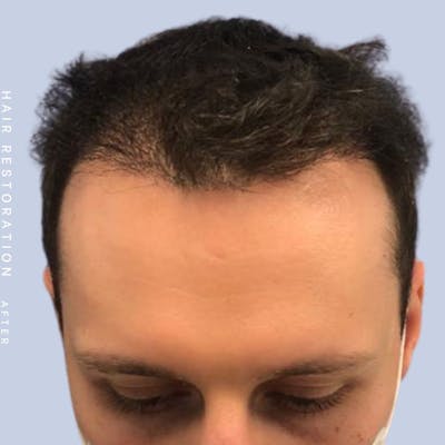 Hair Restoration Before & After Gallery - Patient 121417574 - Image 2