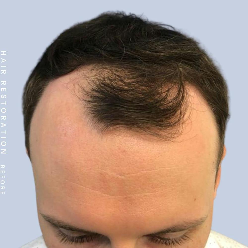 Hair Restoration Before & After Gallery - Patient 121417574 - Image 3