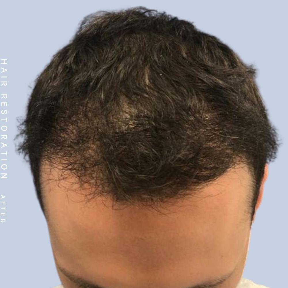 Men's Hair Before & After Gallery - Patient 121417580 - Image 4