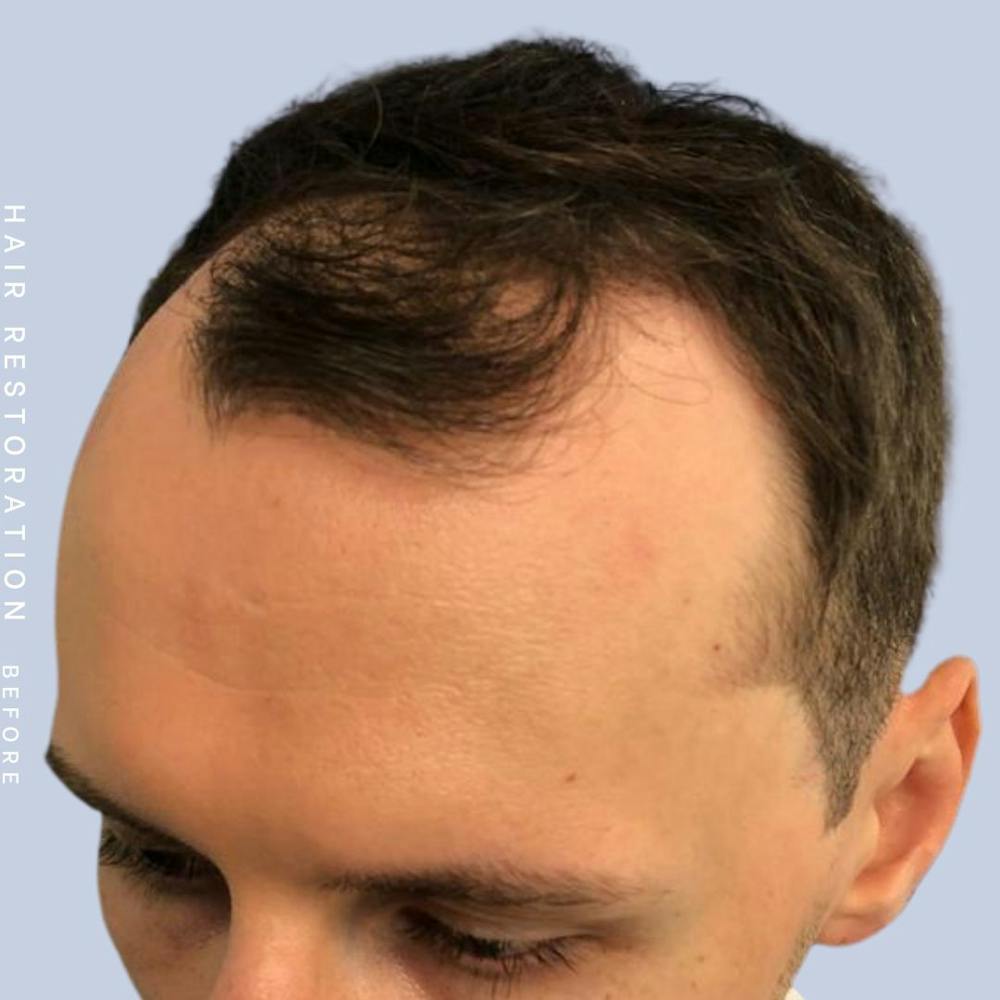 Hair Restoration Before & After Gallery - Patient 121417574 - Image 5