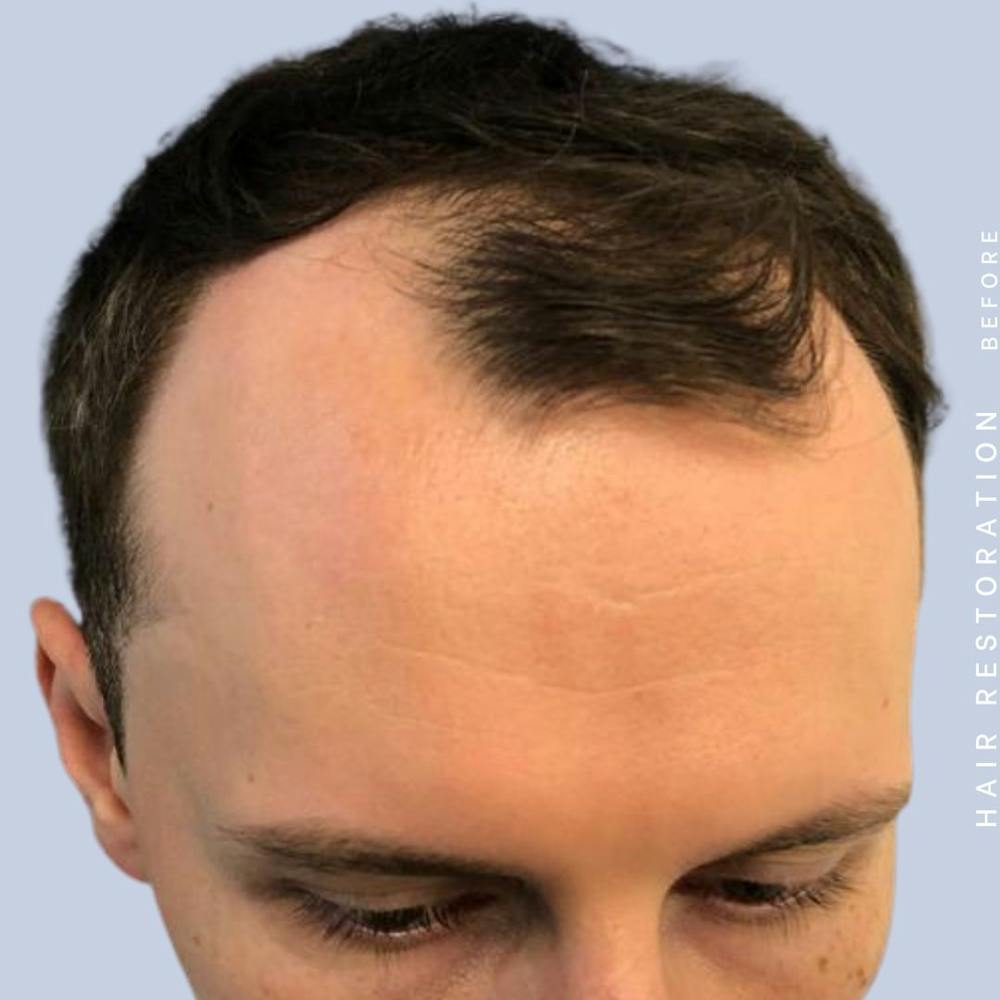 Hair Restoration Before & After Gallery - Patient 121417574 - Image 7