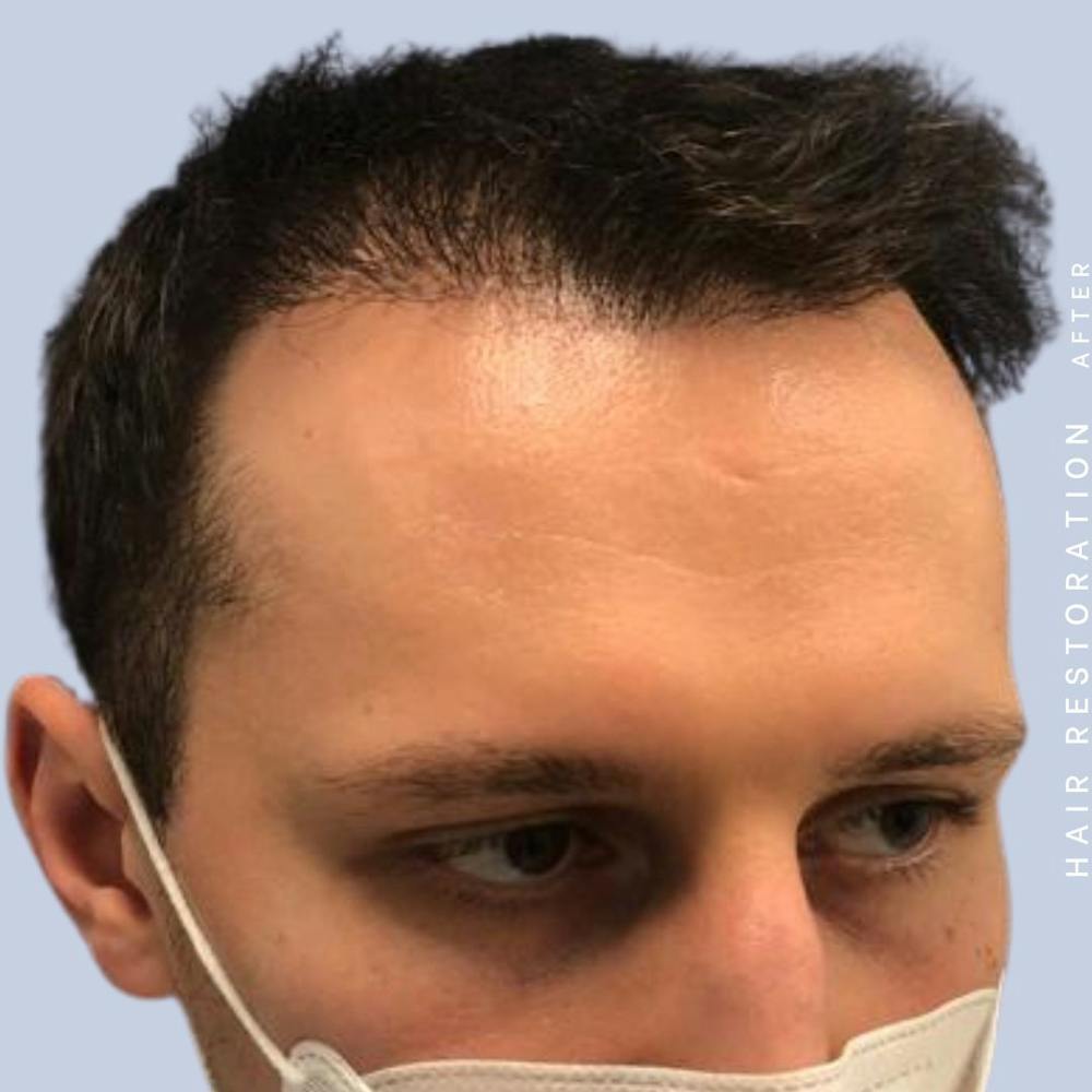 Hair Restoration Before & After Gallery - Patient 121417574 - Image 8