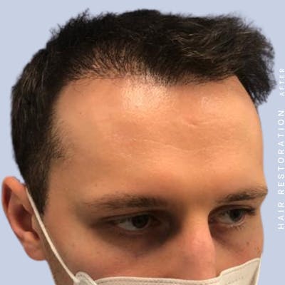 Hair Restoration Before & After Gallery - Patient 121417574 - Image 8