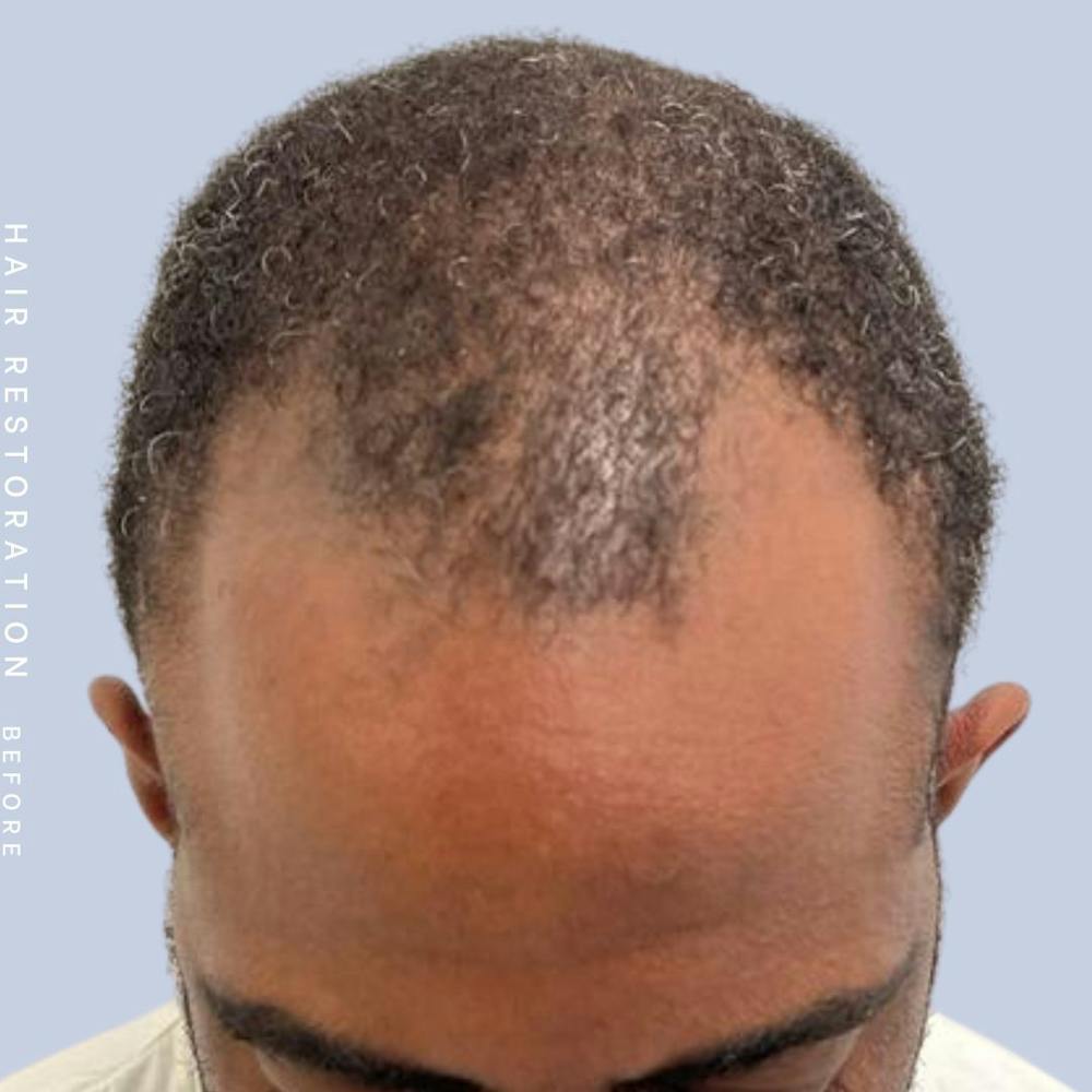 Men's Hair Before & After Gallery - Patient 121417581 - Image 1