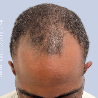 Hair Restoration Before & After Gallery - Patient 121417575 - Image 1