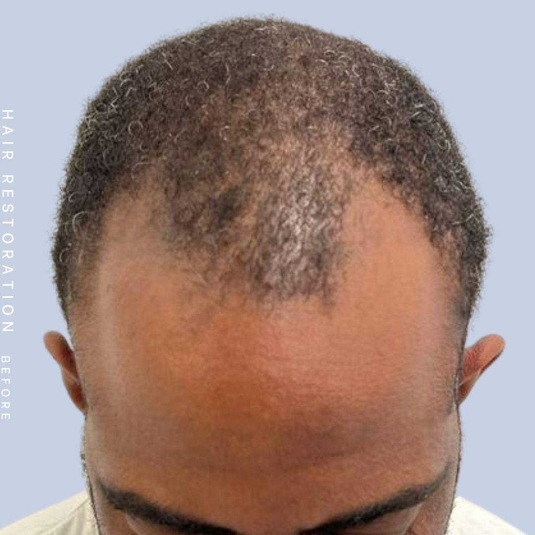 Hair Restoration Before & After Gallery - Patient 121417575 - Image 1