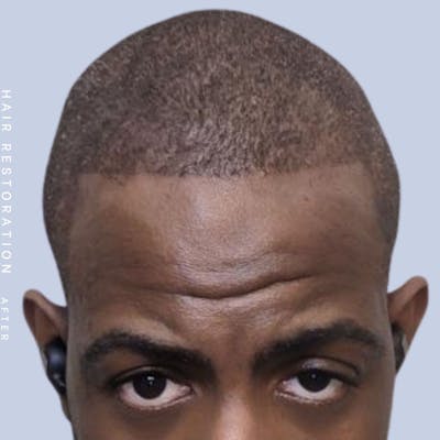 Hair Restoration Before & After Gallery - Patient 121417575 - Image 2