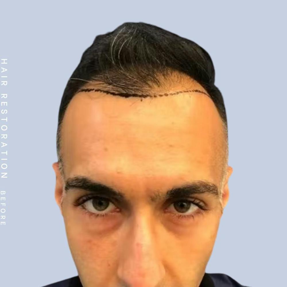 Hair Restoration Before & After Gallery - Patient 121417576 - Image 1
