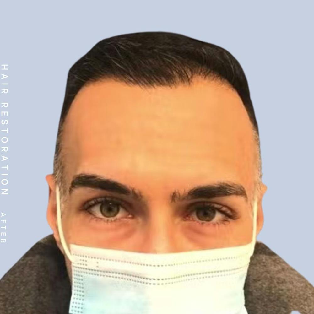 Hair Restoration Before & After Gallery - Patient 121417576 - Image 2
