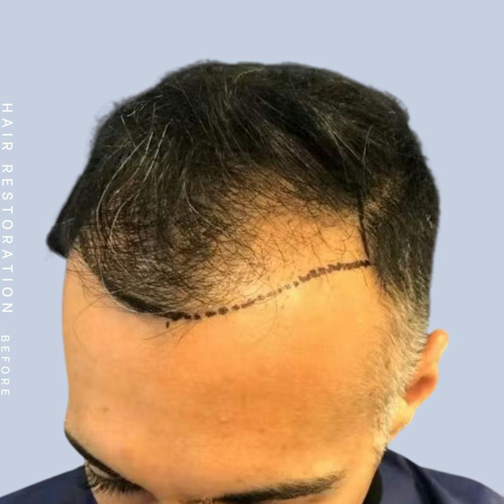 Men's Hair Before & After Gallery - Patient 121417582 - Image 3