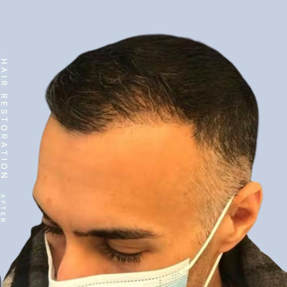 Hair Restoration Before & After Gallery - Patient 121417576 - Image 4