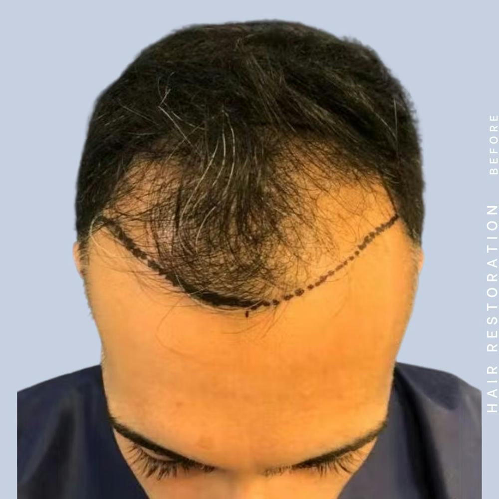 Hair Restoration Before & After Gallery - Patient 121417576 - Image 5