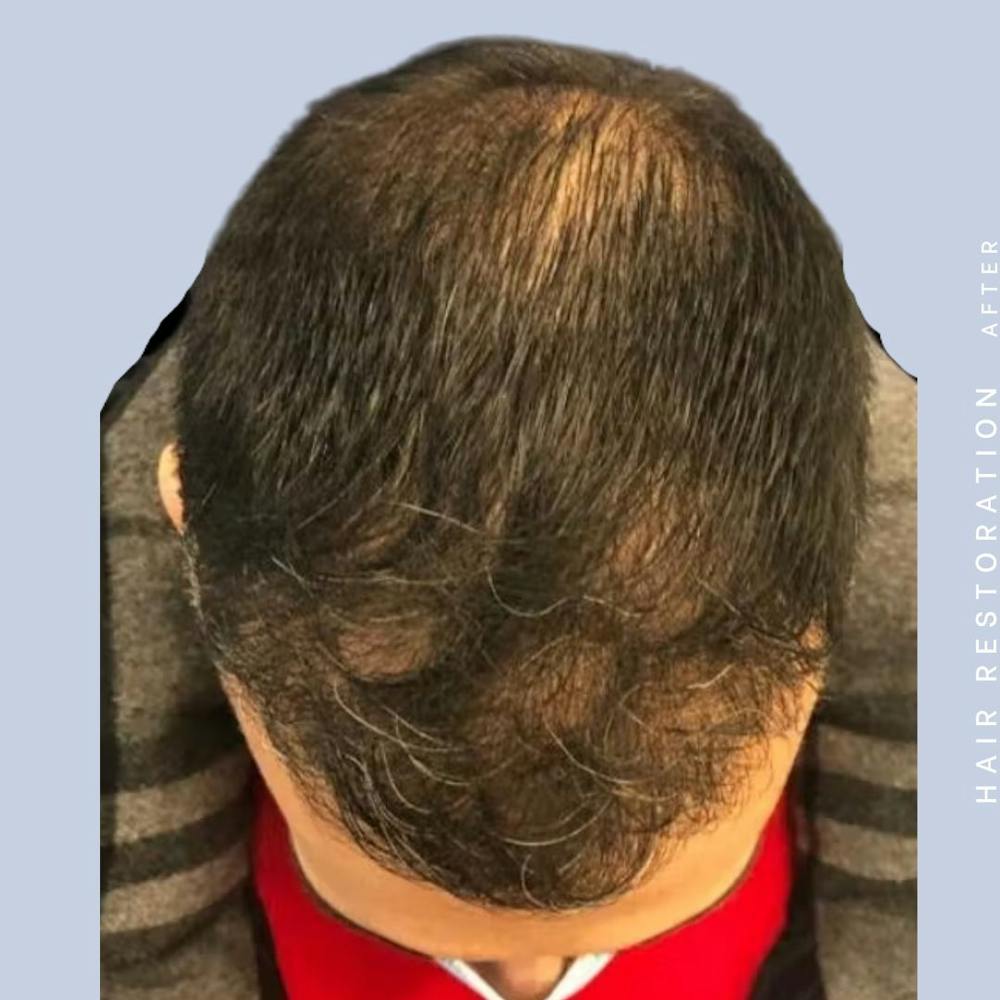 Hair Restoration Before & After Gallery - Patient 121417576 - Image 6