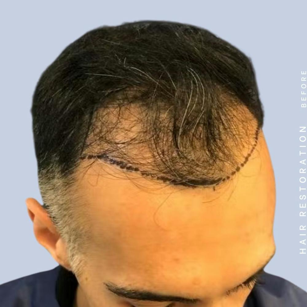 Hair Restoration Before & After Gallery - Patient 121417576 - Image 7