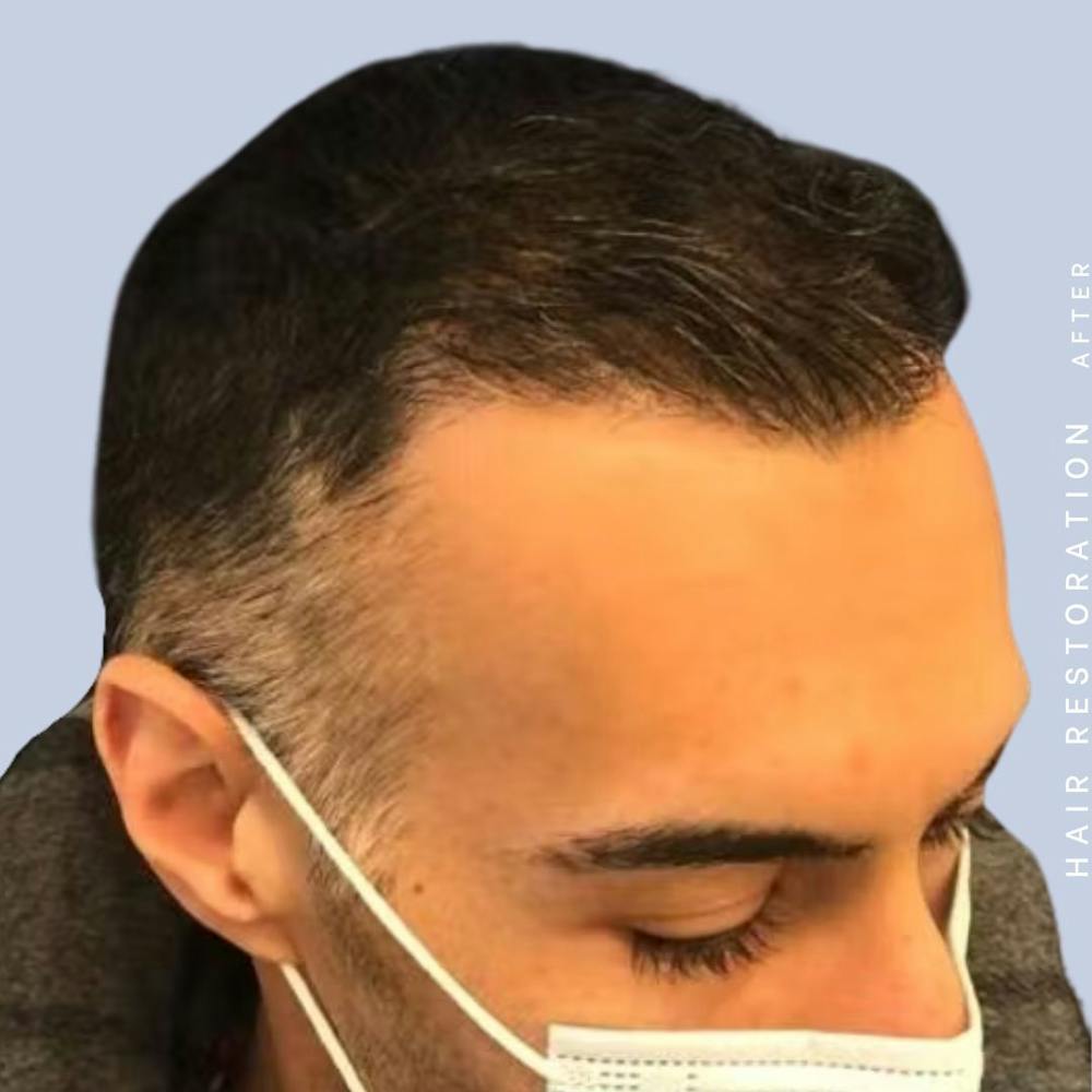 Hair Restoration Before & After Gallery - Patient 121417576 - Image 8