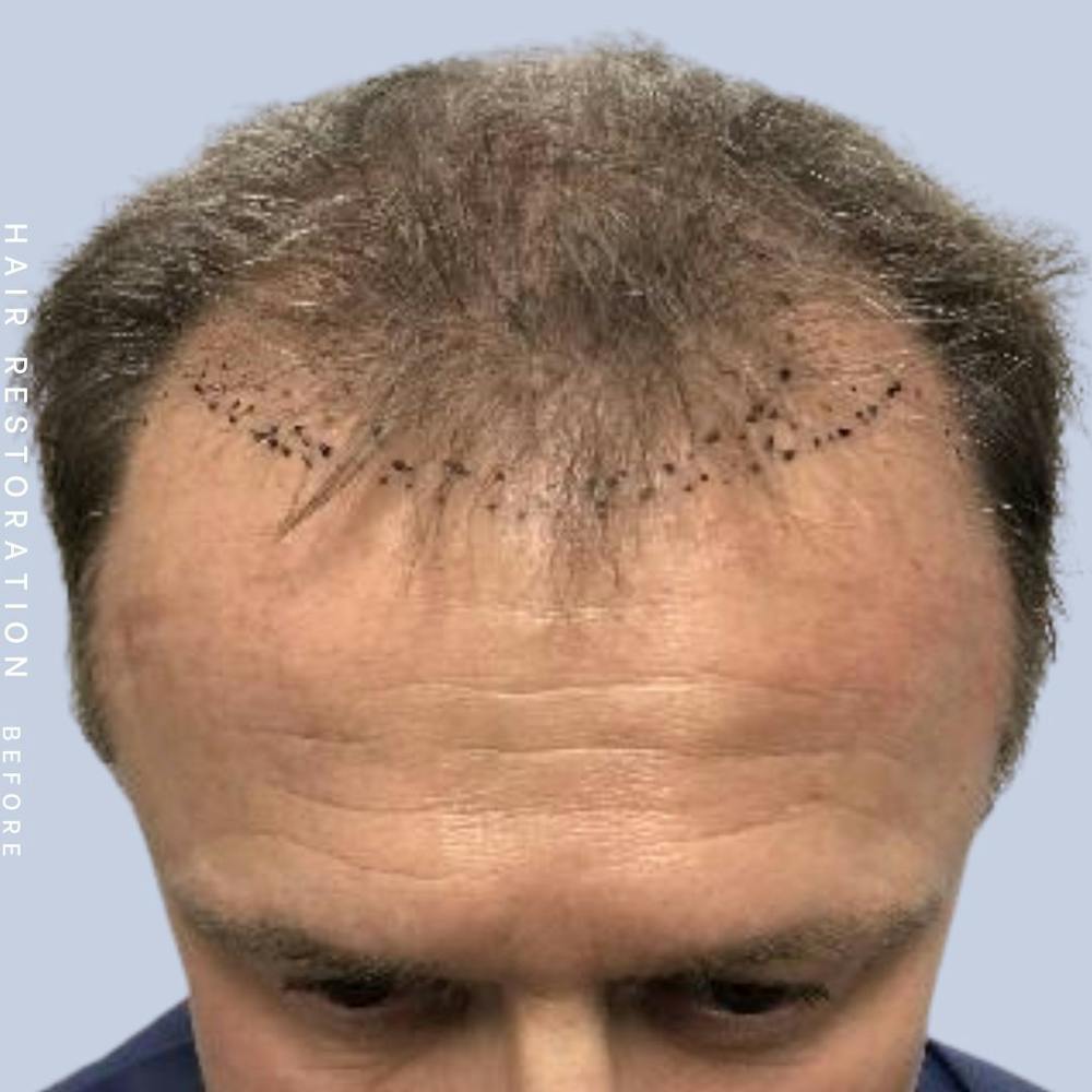 Hair Restoration Before & After Gallery - Patient 121378354 - Image 1