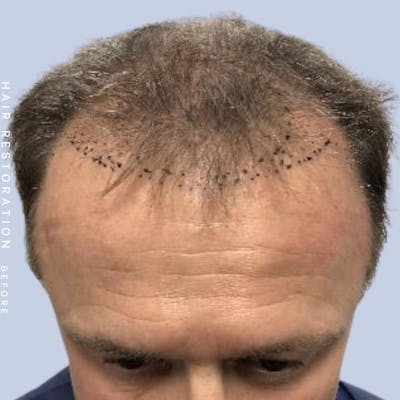 Men's Hair Before & After Gallery - Patient 121378356 - Image 1