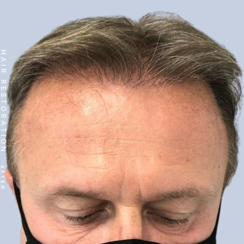 Hair Before & After Gallery - Patient 121378356 - Image 2