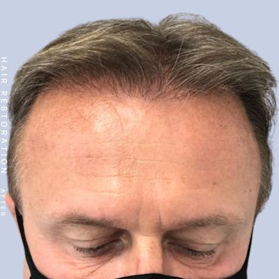 Hair Before & After Gallery - Patient 121378356 - Image 2