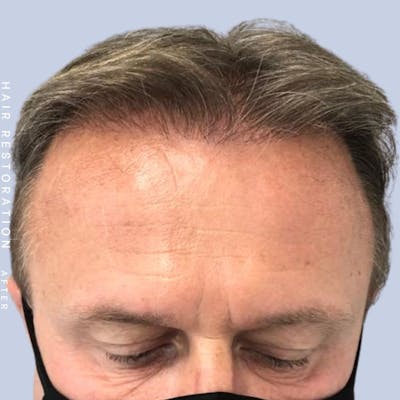 Hair Restoration Before & After Gallery - Patient 121378354 - Image 2