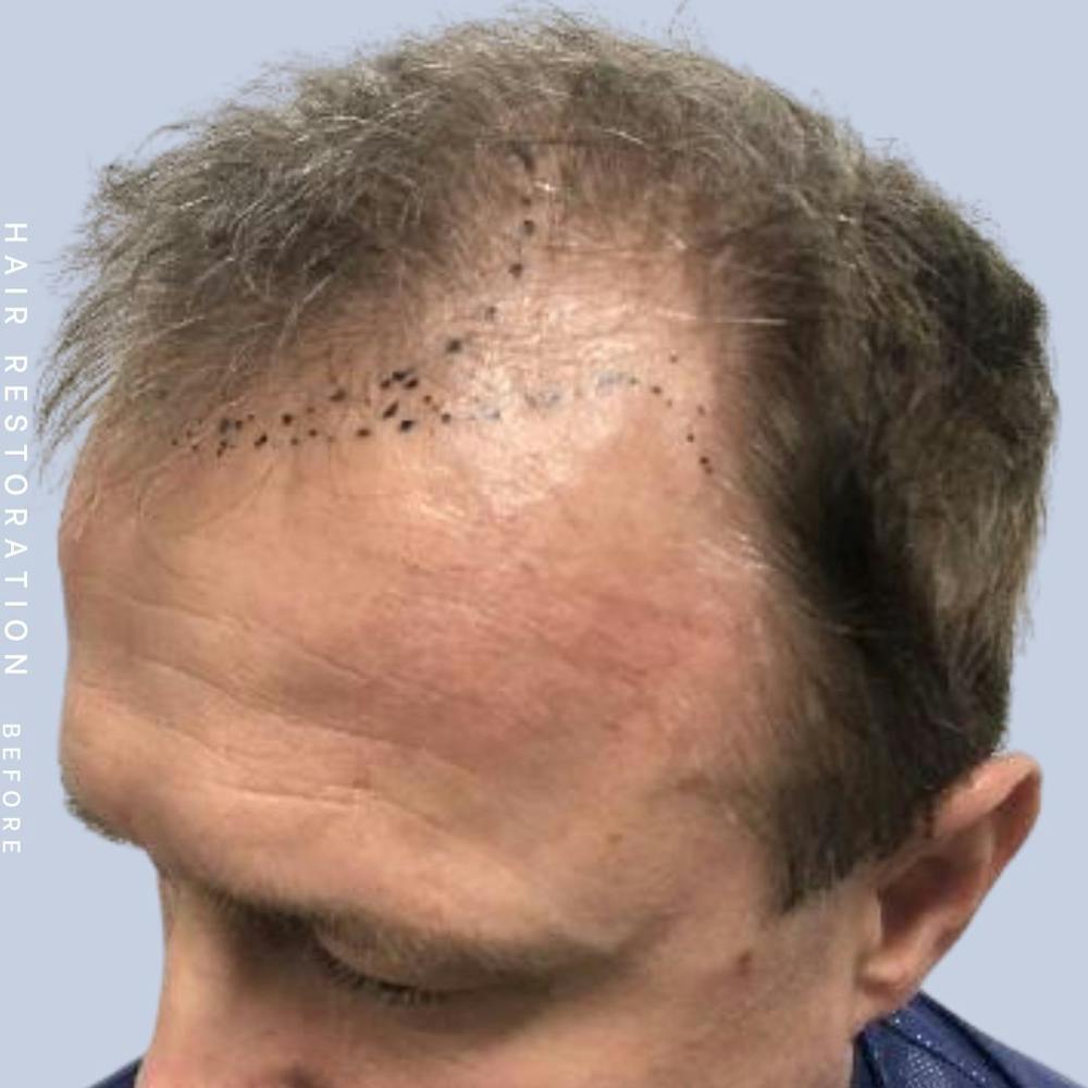 Hair Restoration Before & After Gallery - Patient 121378354 - Image 3