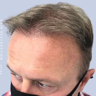 Hair Before & After Gallery - Patient 121378356 - Image 4