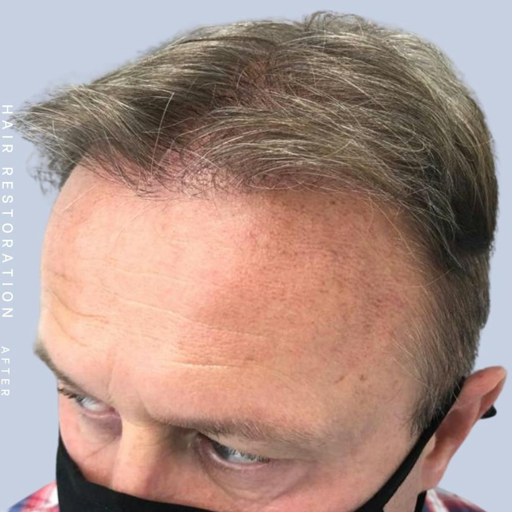 Hair Restoration Before & After Gallery - Patient 121378354 - Image 4