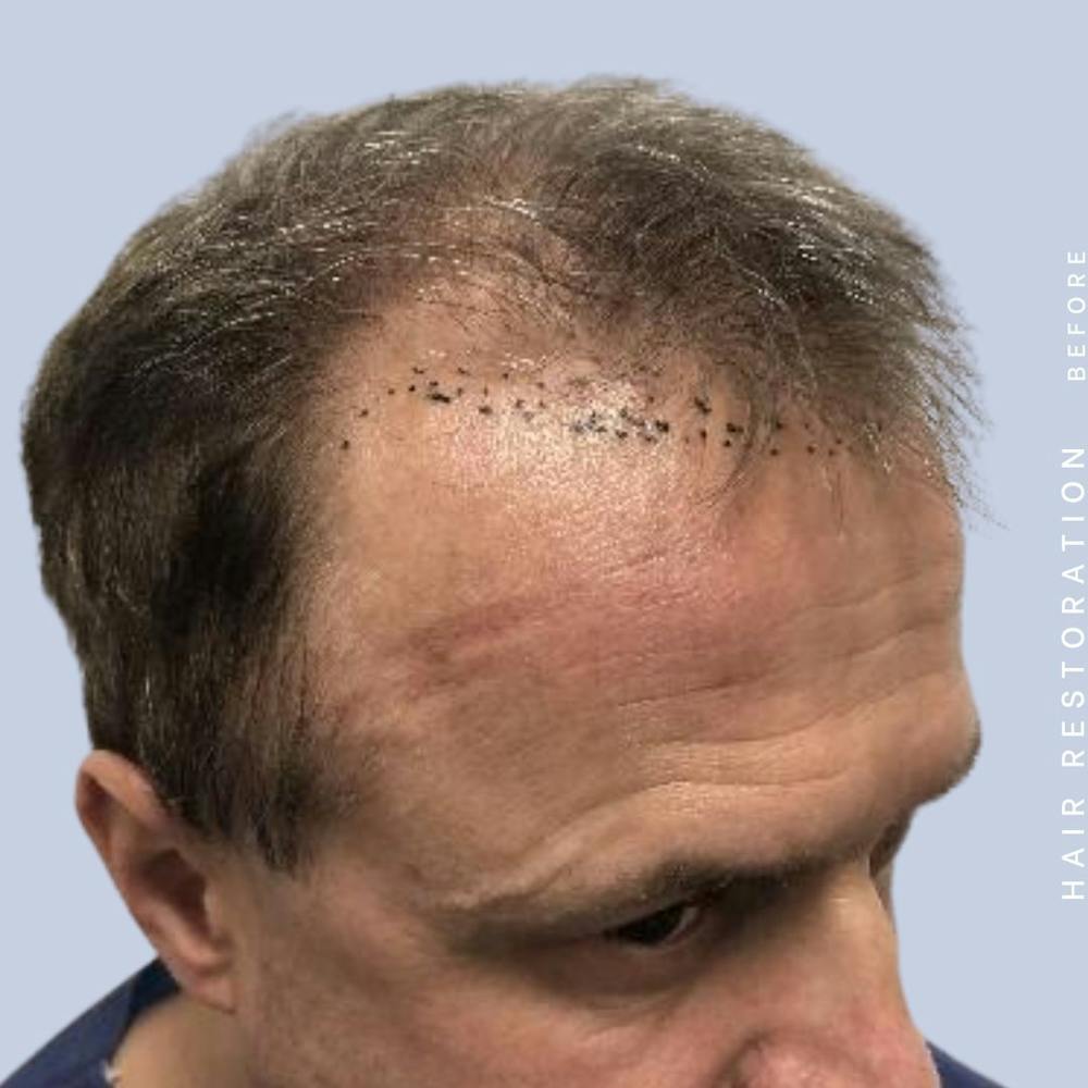 Men's Hair Before & After Gallery - Patient 121378356 - Image 5