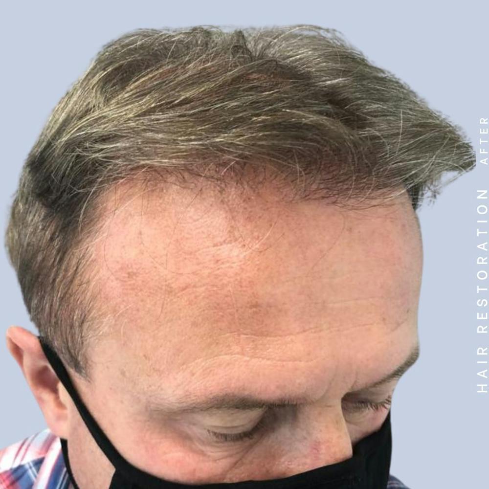 Hair Restoration Before & After Gallery - Patient 121378354 - Image 6