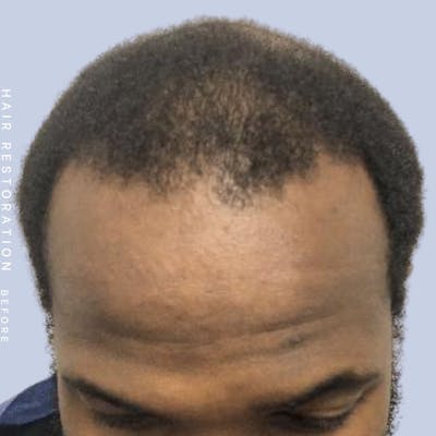 Hair Restoration Before & After Gallery - Patient 121377754 - Image 1