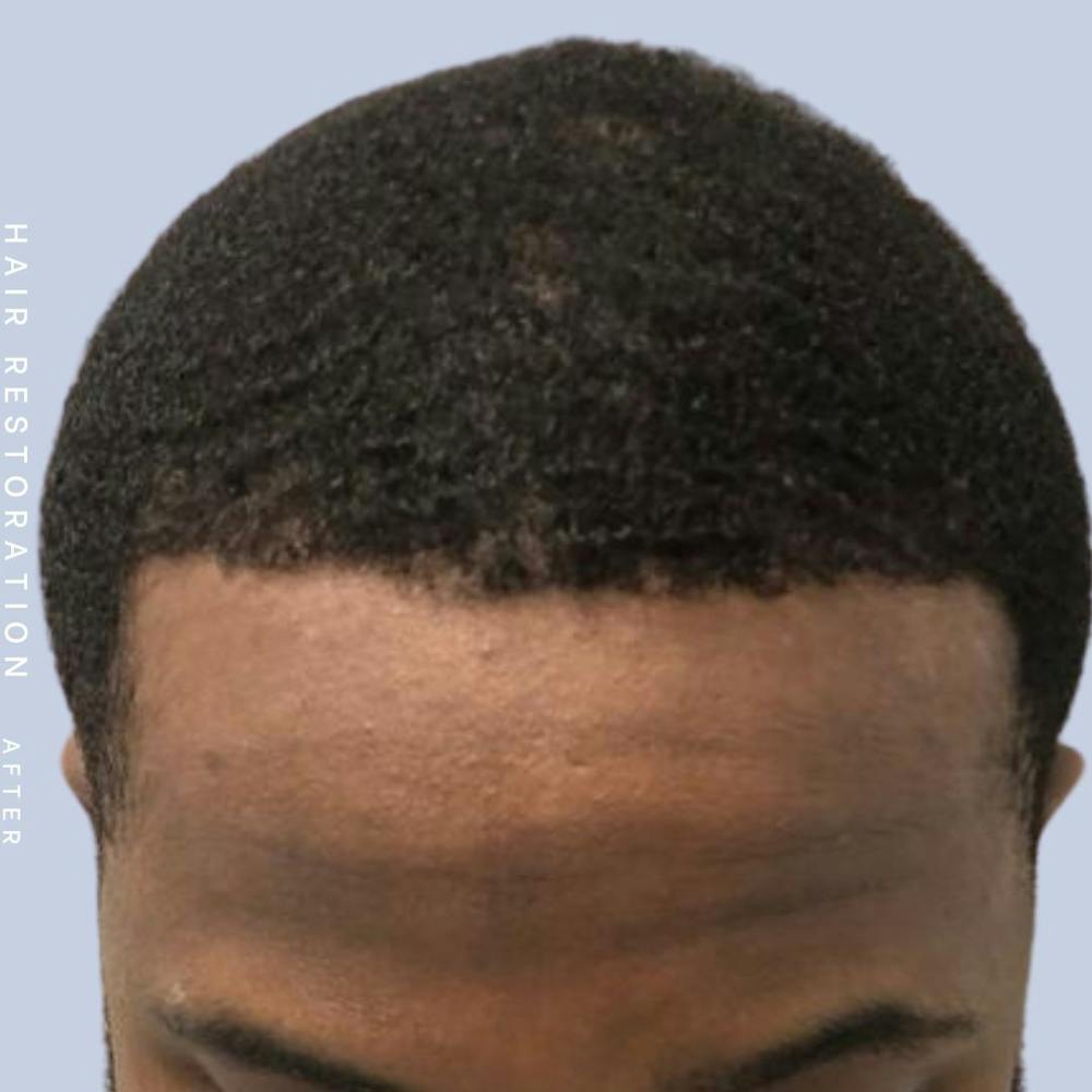 Men's Hair Before & After Gallery - Patient 121377745 - Image 2