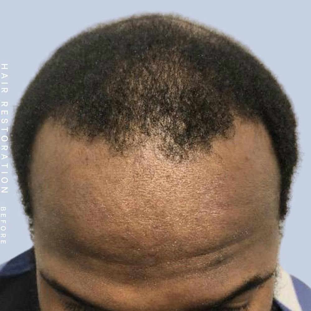 Men's Hair Before & After Gallery - Patient 121377745 - Image 3