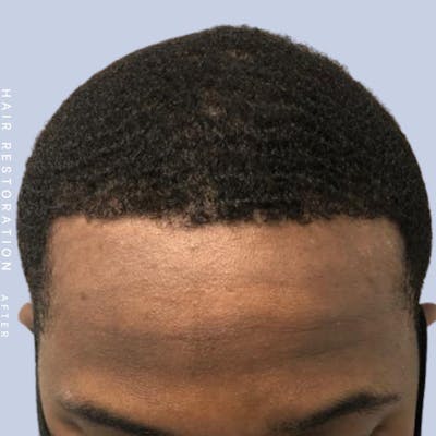 Hair Restoration Before & After Gallery - Patient 121377754 - Image 4