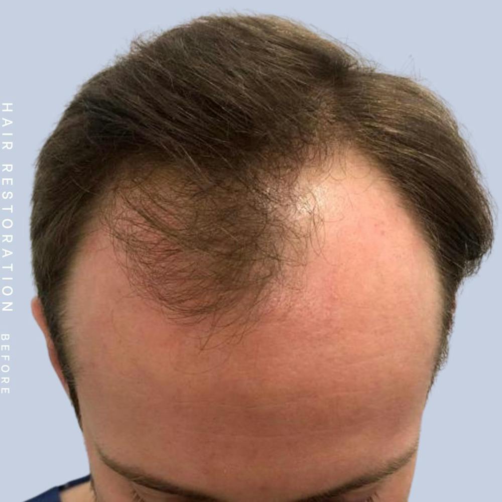 Men's Hair Before & After Gallery - Patient 359931 - Image 1