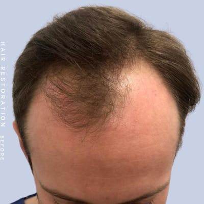 Men's Hair Before & After Gallery - Patient 121377763 - Image 1