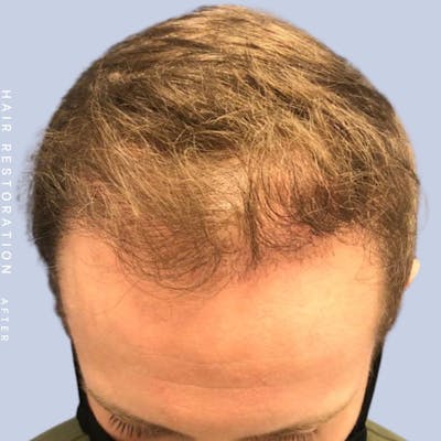 Hair Restoration Before & After Gallery - Patient 121377762 - Image 2