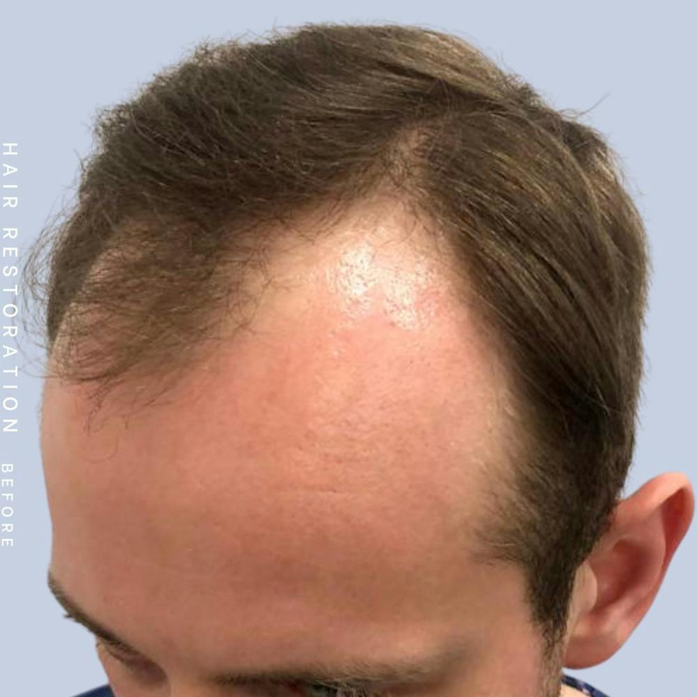 Hair Restoration Before & After Gallery - Patient 121377762 - Image 3