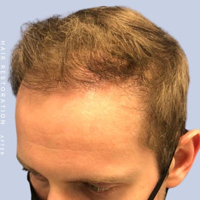 Hair Restoration Before & After Gallery - Patient 121377762 - Image 4