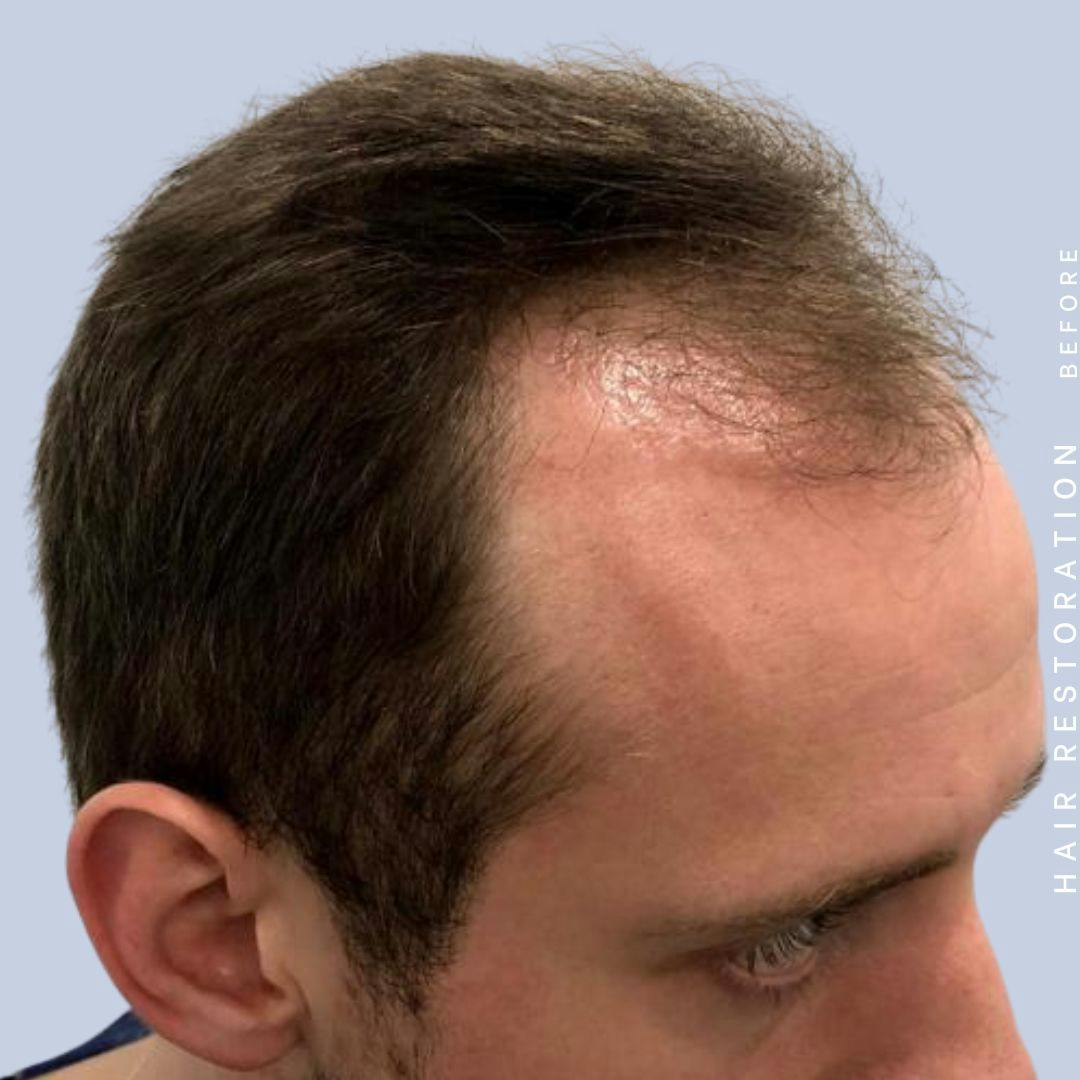 Hair Restoration Before & After Gallery - Patient 121377762 - Image 3