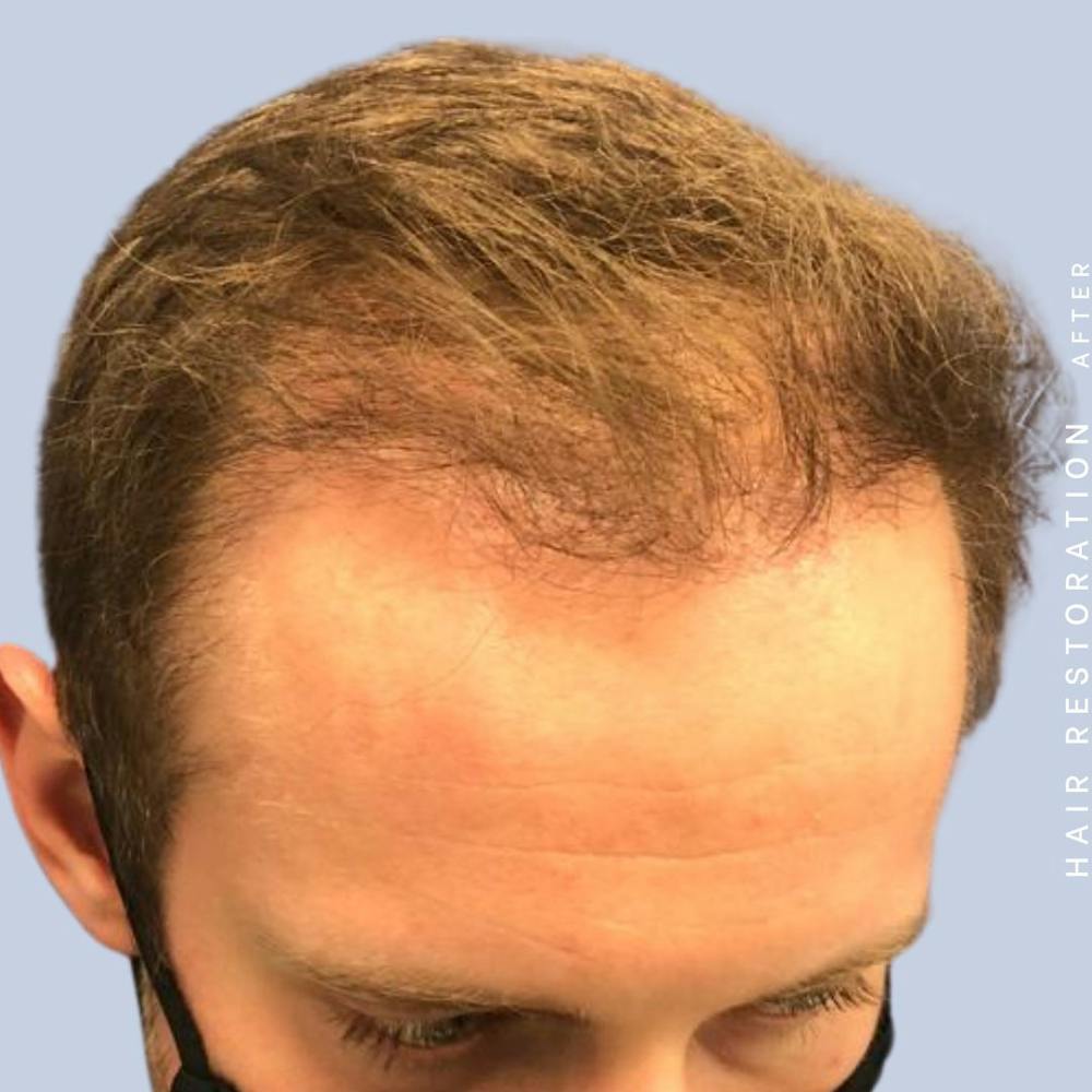 Men's Hair Before & After Gallery - Patient 121377763 - Image 6