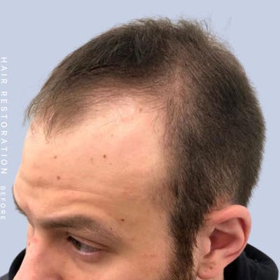 Men's Hair Before & After Gallery - Patient 108745183 - Image 1