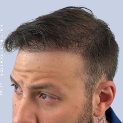 Hair Restoration Before & After Gallery - Patient 108743802 - Image 2