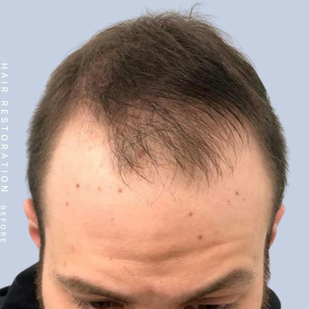Hair Restoration Before & After Gallery - Patient 108743802 - Image 3