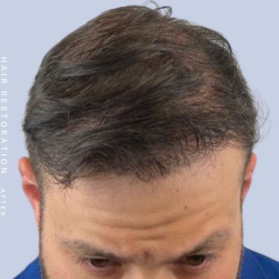 Hair Restoration Before & After Gallery - Patient 108743802 - Image 4