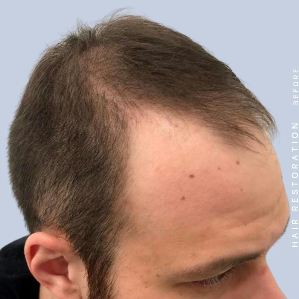 Men's Hair Before & After Gallery - Patient 108745183 - Image 5