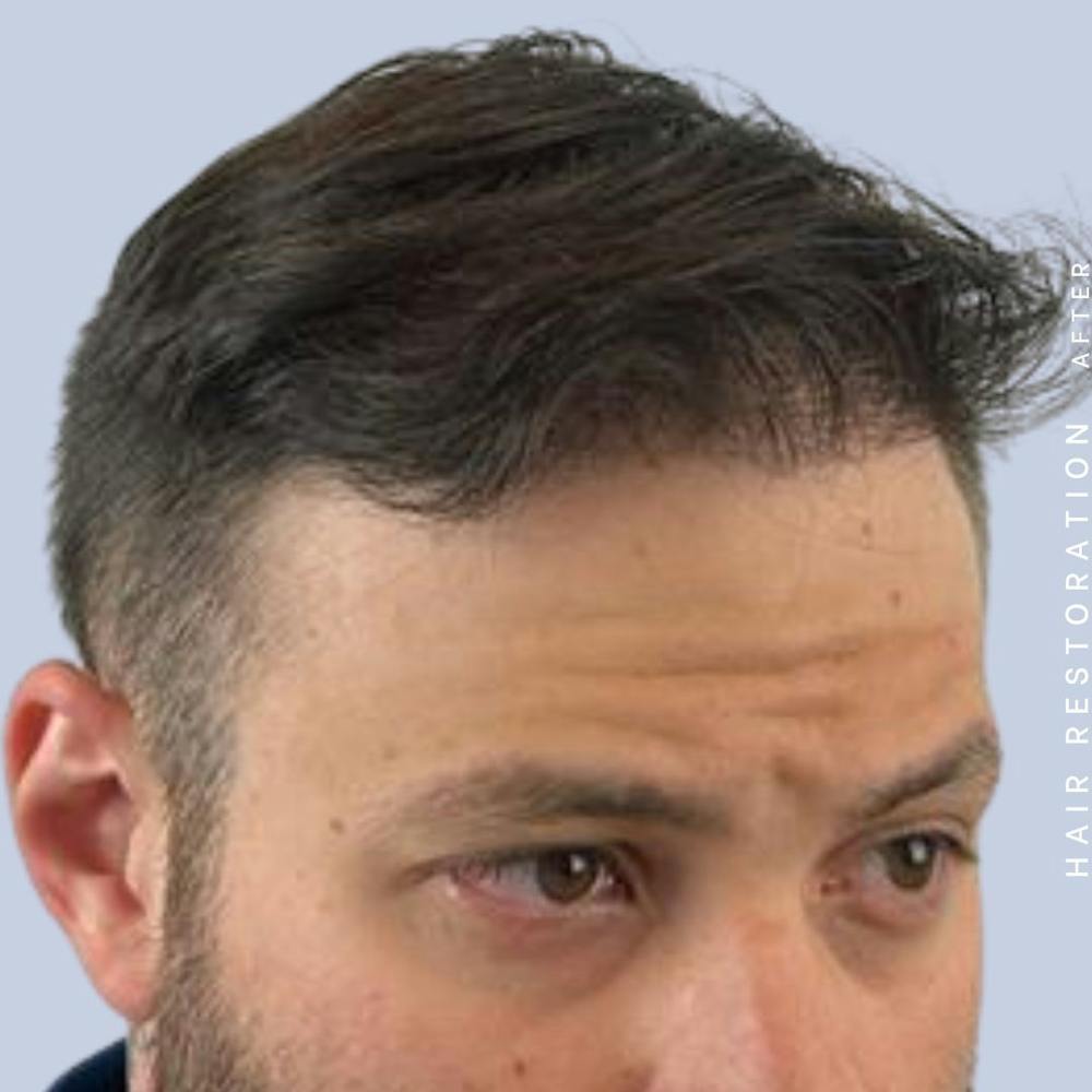 Hair Restoration Before & After Gallery - Patient 108743802 - Image 6