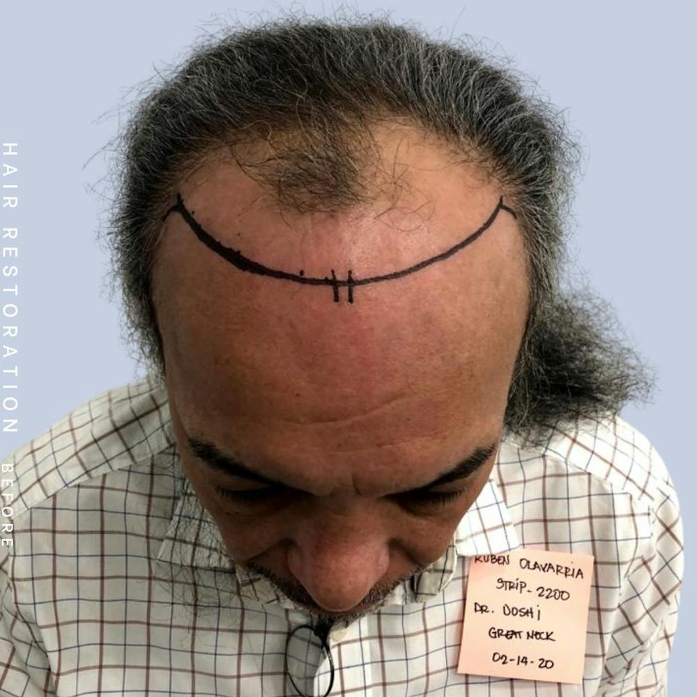Hair Restoration Before & After Gallery - Patient 108743800 - Image 1