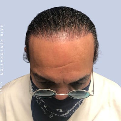 Hair Restoration Before & After Gallery - Patient 108743800 - Image 2