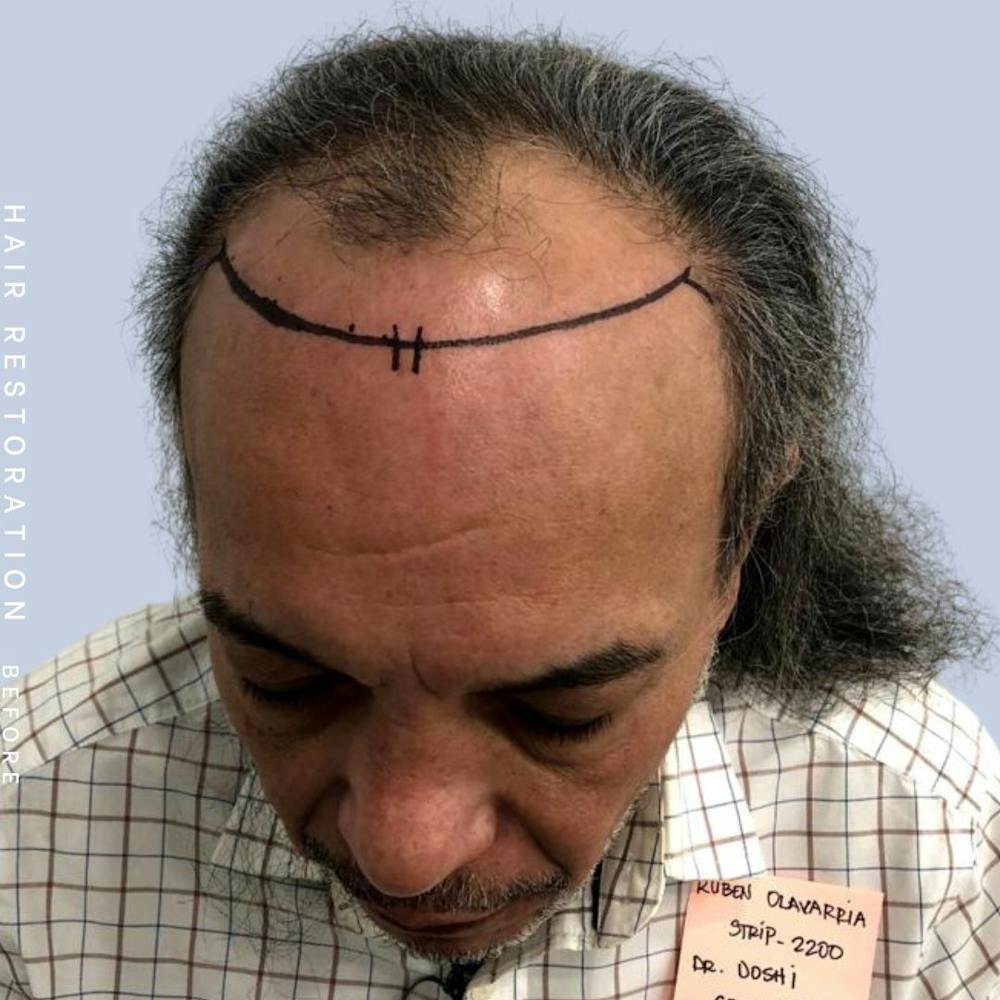 Hair Restoration Before & After Gallery - Patient 108743800 - Image 3