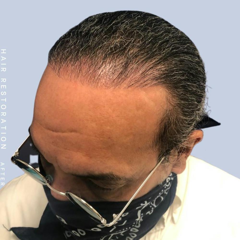 Hair Restoration Before & After Gallery - Patient 108743800 - Image 4